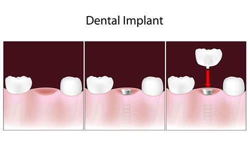 Dental Implants in Concord MA
