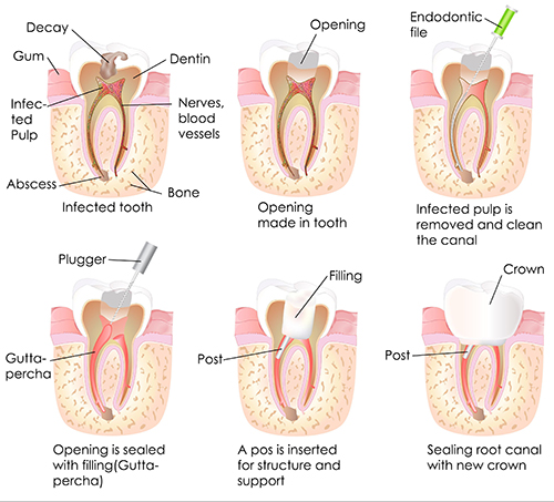 Root Canal in Concord MA